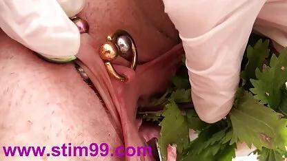 বিচ্ছু বিচ্ছু এবং ভালভায় মূত্রনালী anastomosis
