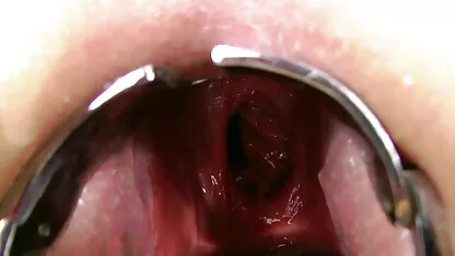 ডাবল পায়ু প্রোবের দূরত্ব